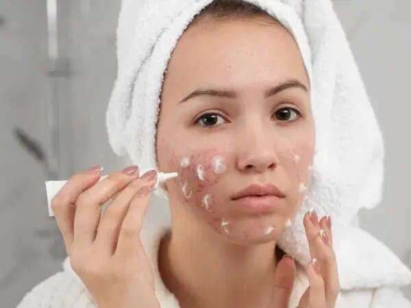 Cilt Sorunlarının Gizli Tetikleyicileri: Sivilceye Neden Olan 10 Alışkanlık – Son Dakika Hayat Haberleri