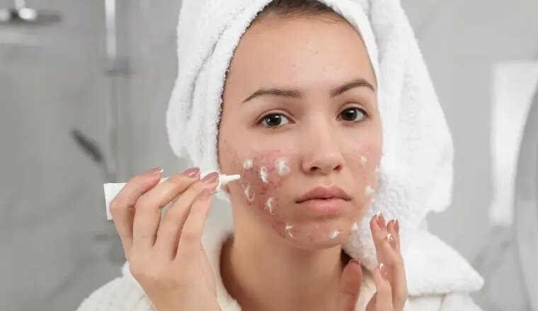 Cilt Sorunlarının Gizli Tetikleyicileri: Sivilceye Neden Olan 10 Alışkanlık – Son Dakika Hayat Haberleri